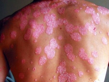 Enfermidade psoriásica